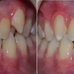 Broken front teeth restored with CAD/CAM porcelain restorations (Empress CAD)